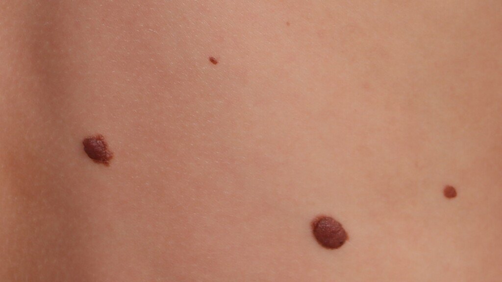 Can Small, Tiny Moles Turn Into Melanoma? » Scary Symptoms