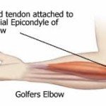 Best Exercises to Heal Golfer's Elbow