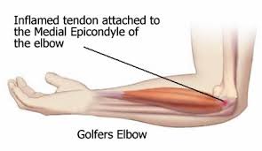 Best Exercises to Heal Golfer's Elbow