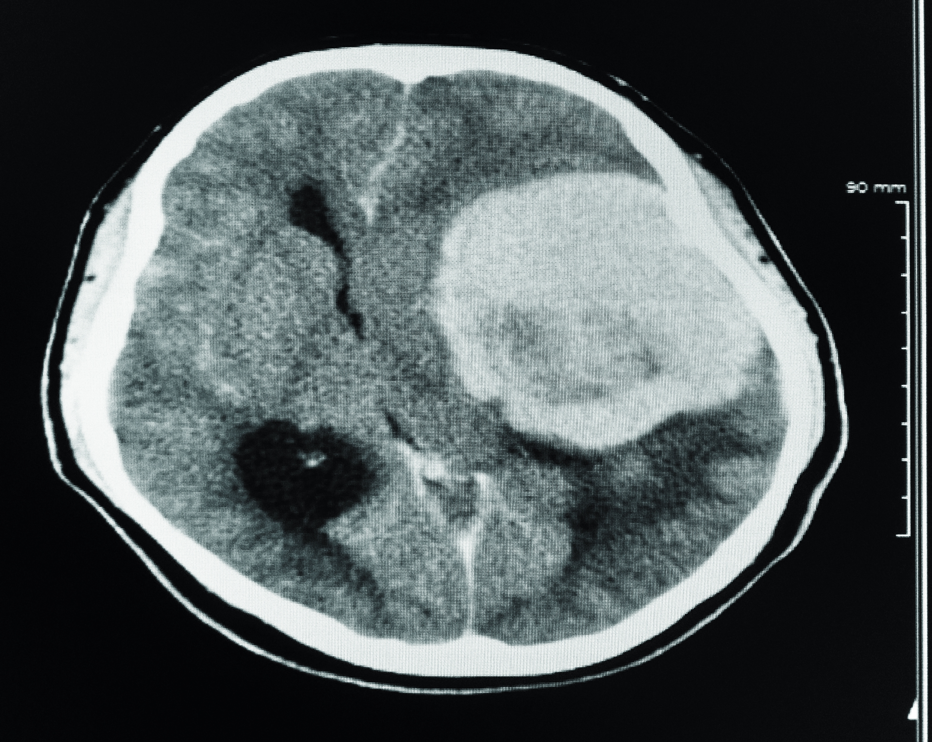 Can a CT Scan Detect a Brain Tumor? » Scary Symptoms