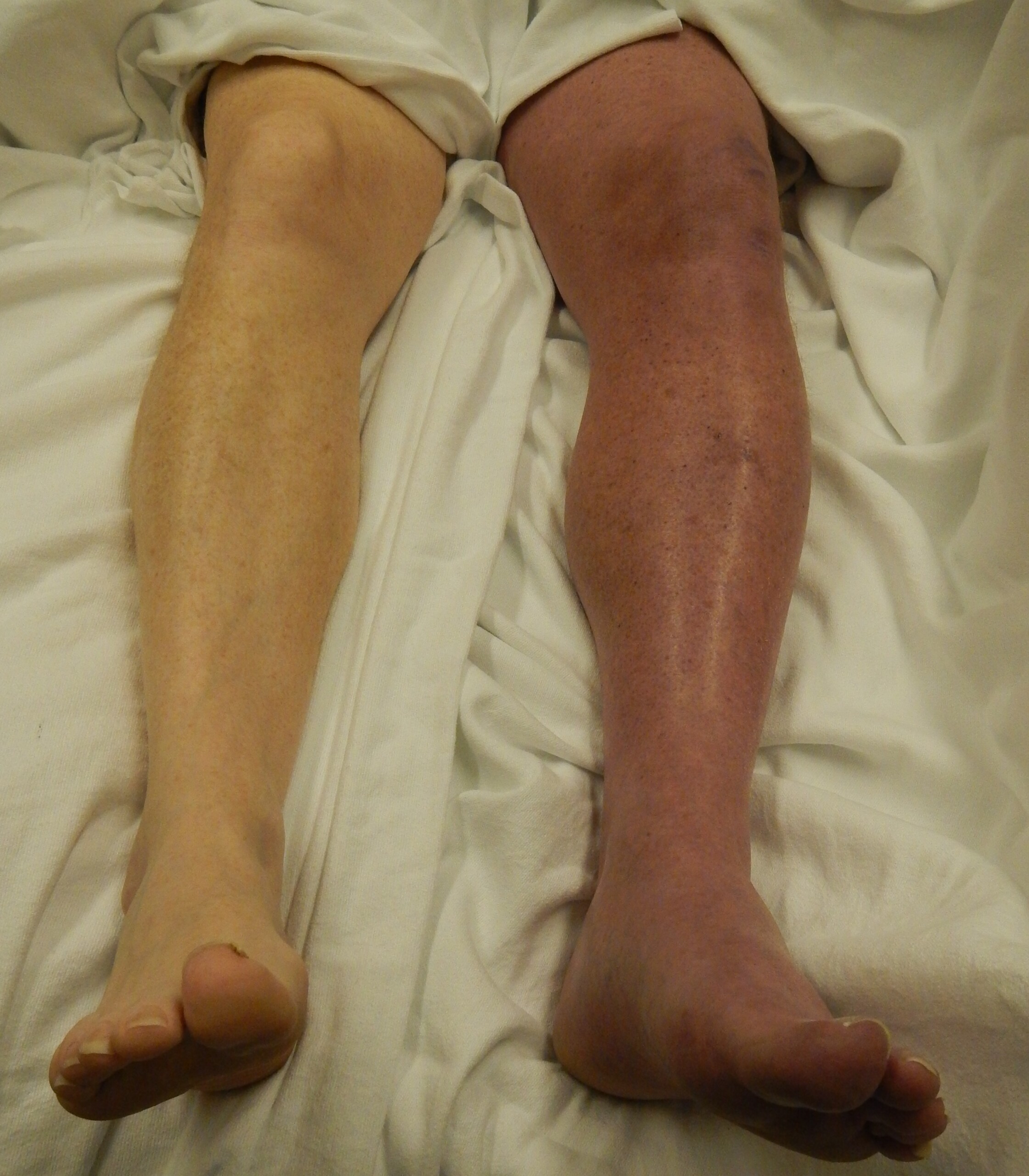 How Do Stockings Prevent Blood Clots after Surgery?
