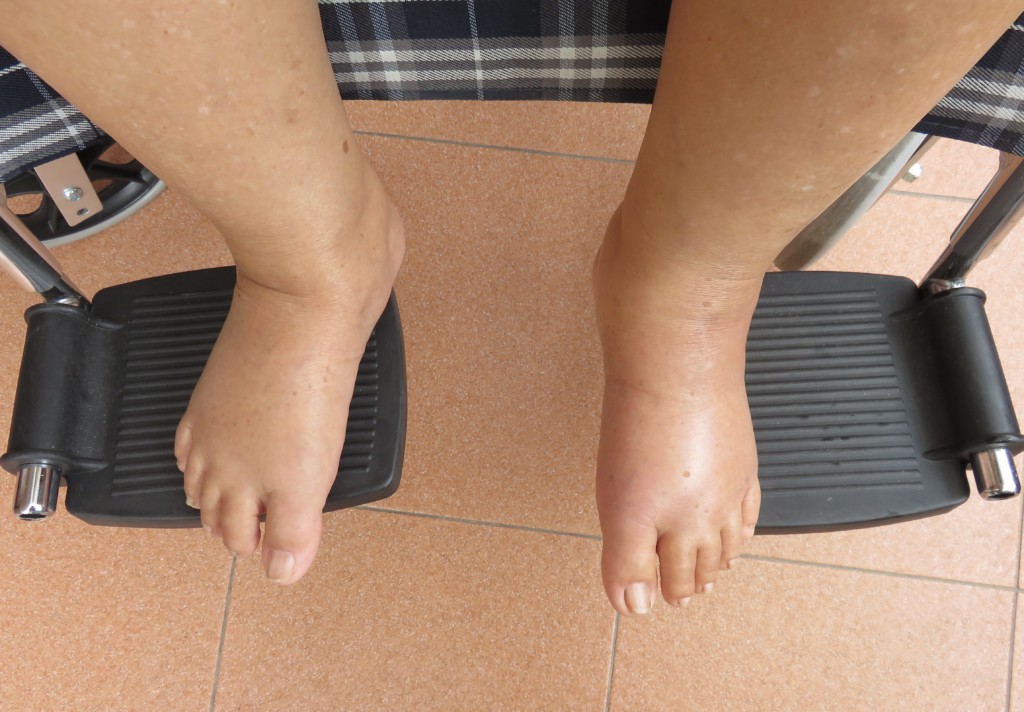 Edema, Swelling in Legs from Obesity vs. Heart Failure » Scary Symptoms