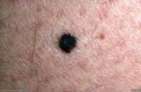 How Common Is Melanoma Black; Can a Normal Mole Be Black? » Scary Symptoms