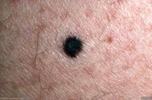 Can Melanoma Be Perfectly Round, Symmetrical, One Color? » Scary Symptoms