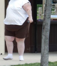 Edema, Swelling in Legs from Obesity vs. Heart Failure » Scary Symptoms