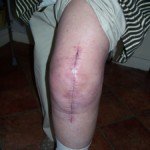 Swelling from DVT vs. Joint Replacement Fluid Retention