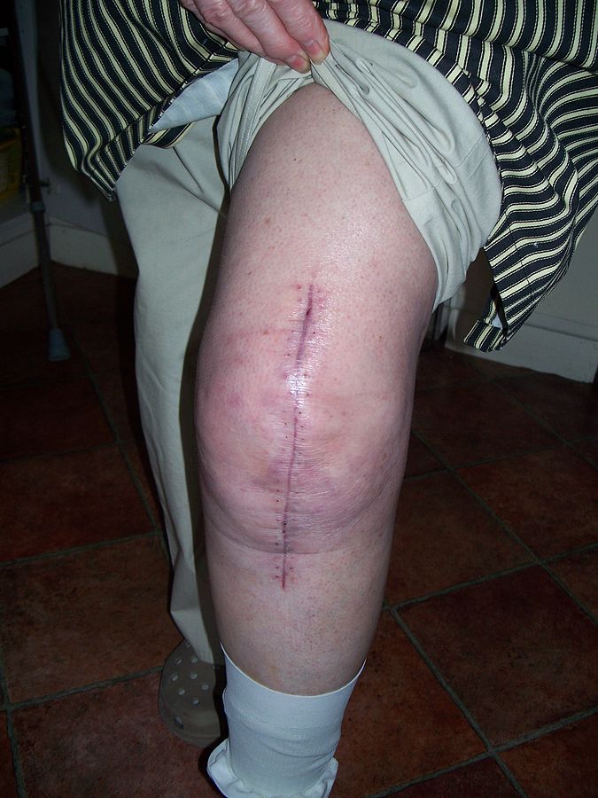 Why You Have Pain Soon After Revision Knee Replacement