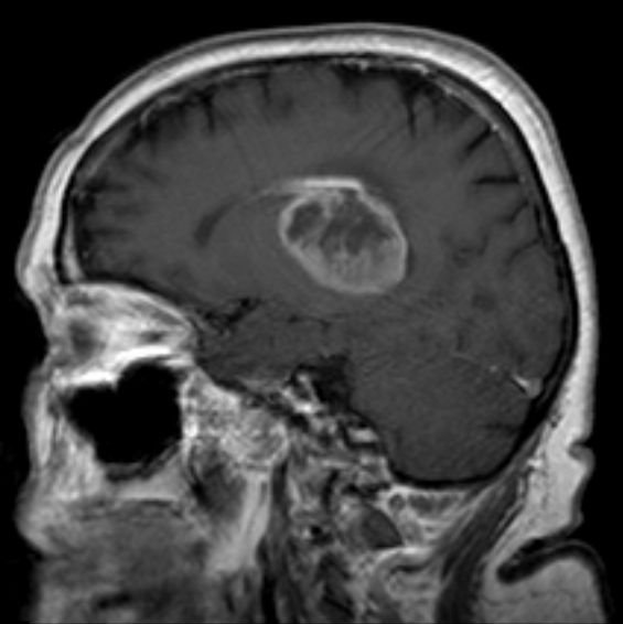 Can MRI Wrongly Show High Grade Glioma that’s Really Low Grade?