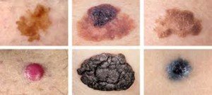 Can Melanoma Be Perfectly Round, Symmetrical, One Color? » Scary Symptoms