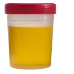 Just What IS “Cloudy” Urine? Its Appearance and Color