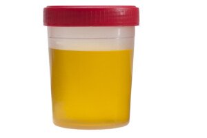 Just What IS “Cloudy” Urine? Its Appearance and Color