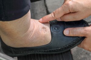 Causes of MILD vs. Severe Bilateral Ankle Swelling