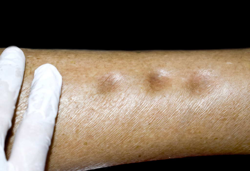 When Those Scary Sock Indentations Don't Mean Edema » Scary Symptoms