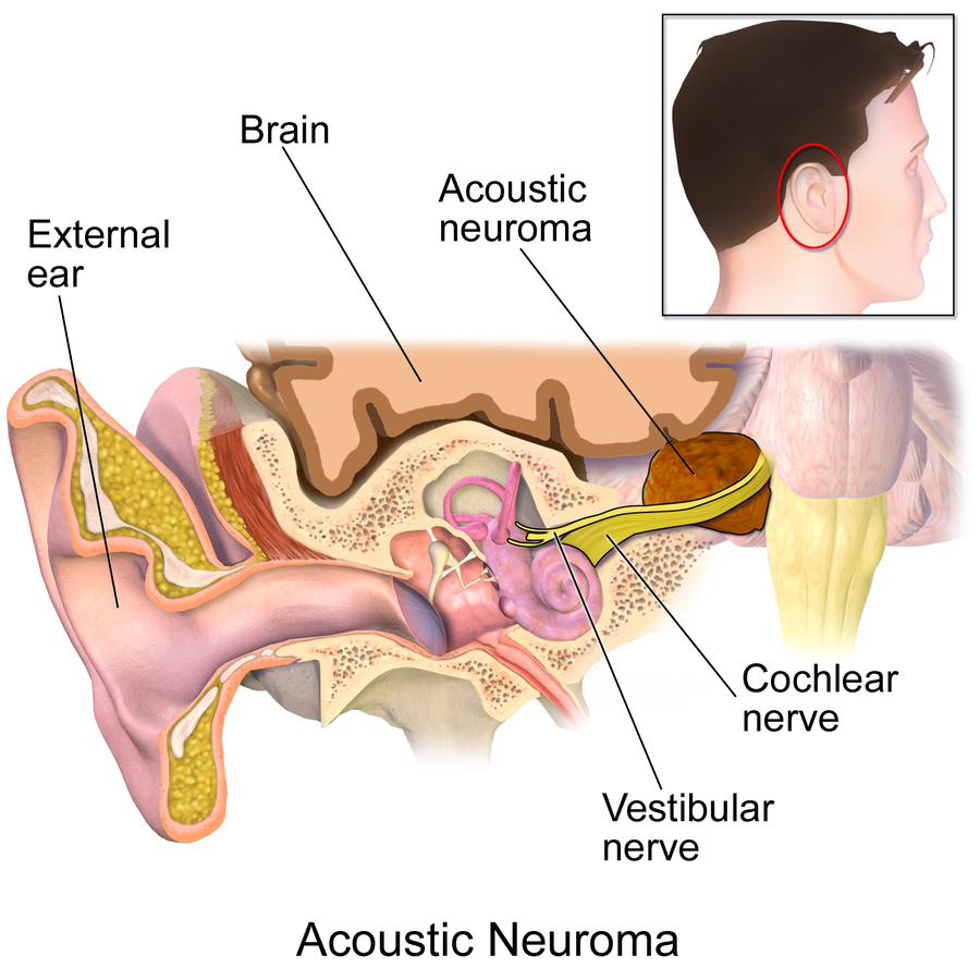 Is There a Drug that Can Stop Acoustic Neuroma Growth ?