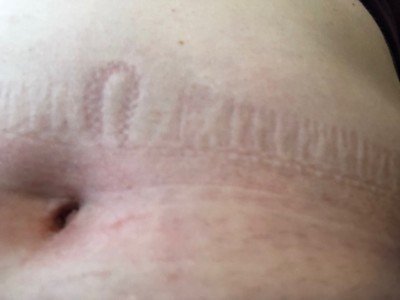 Do Skin Indents from Underwear or Pants Mean a Heart Problem? » Scary ...