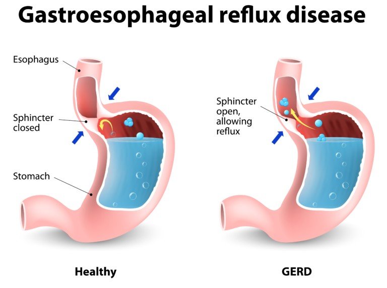 can-gastritis-cause-chest-pain