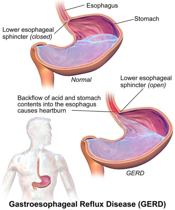 Acid Reflux - Increases Cancer Risk, Can Affect Throat » Scary Symptoms
