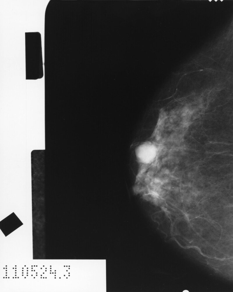 Can Breast Cancer Go Away on Its Own Without Treatment? » Scary Symptoms
