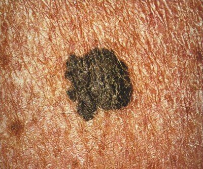 How Common Is Melanoma Black; Can a Normal Mole Be Black? » Scary Symptoms