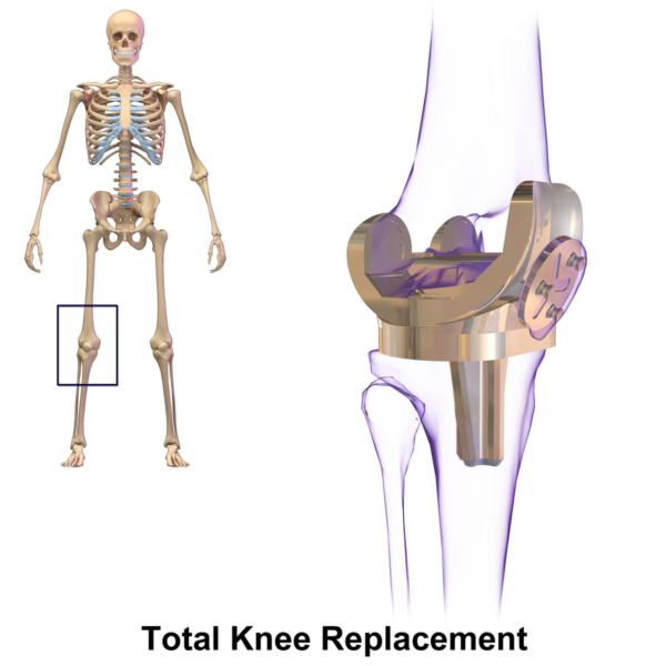 General Anesthesia vs. Regional for Knee Replacement Surgery » Scary