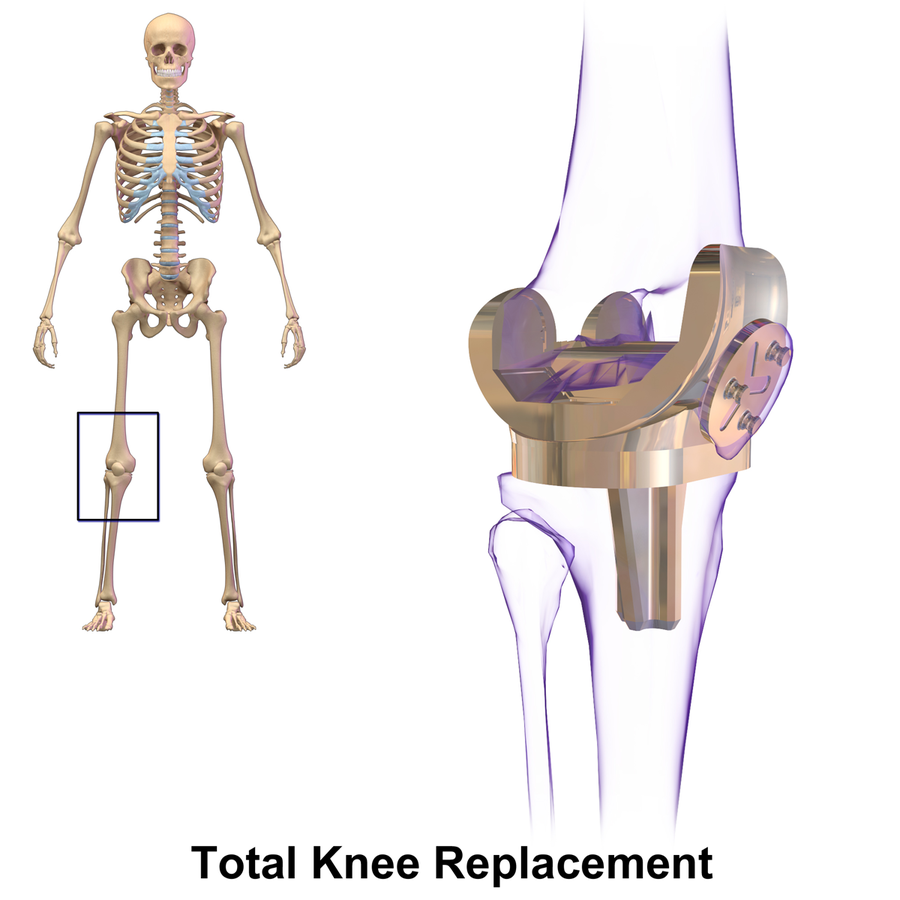 General Anesthesia vs. Regional for Knee Replacement Surgery