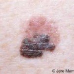 Where on the Body Most Fatal Melanomas Are Located