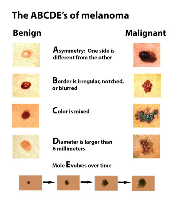 Is a Malignant Melanoma Different than just “Melanoma”? » Scary Symptoms