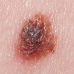 New Moles in Middle Age People: Melanoma or Benign?