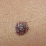 How Fast Can Melanoma Spread After It First Appears?