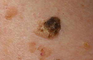 Seborrheic keratosis