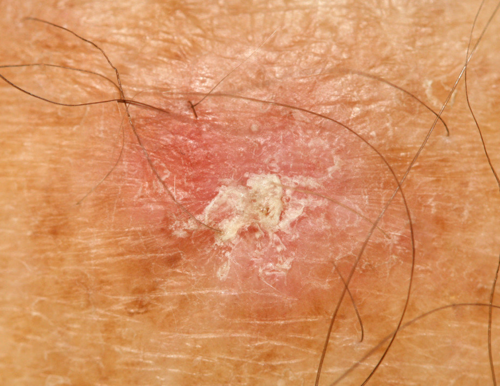 Can Skin Cancer Come and Go? » Scary Symptoms