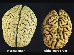 Alzheimer’s Breakthrough: Prevent Disease with Common Painkiller?