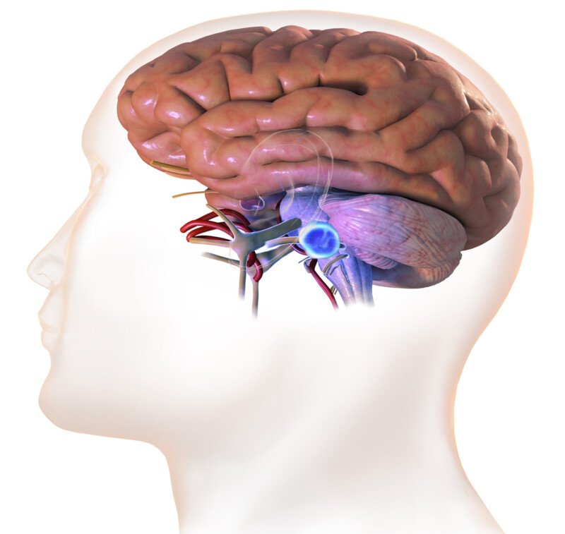 Side Effects of Gamma Knife for Acoustic Neuroma Surgery » Scary Symptoms