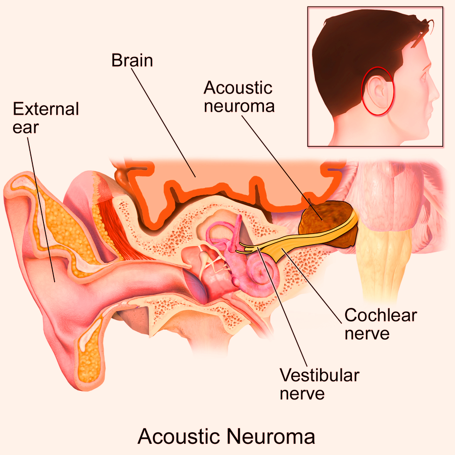 Acoustic Neuroma (vestibular Schwannoma)