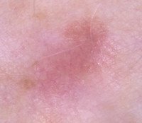 How to Spot a Melanoma that’s Flesh or Pink Colored » Scary Symptoms