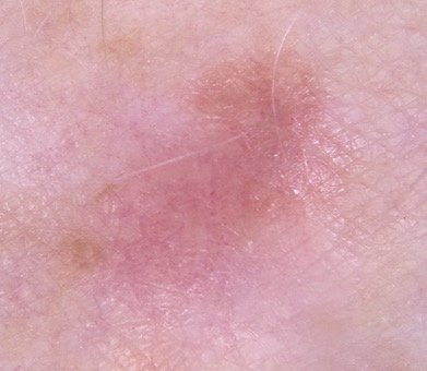 How to Spot a Melanoma that’s Flesh or Pink Colored