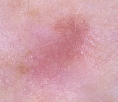 How to Spot a Melanoma that’s Flesh or Pink Colored — Scary Symptoms