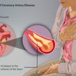 Can the “Good Cholesterol” HDL Ever Be Too High?