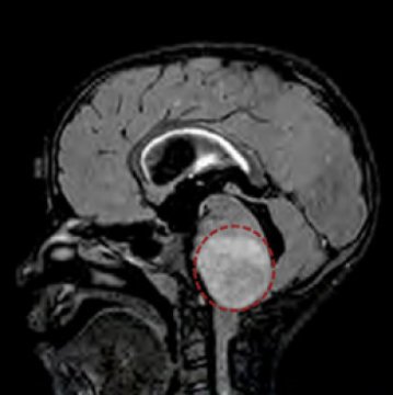 One Eye Suddenly Turns Inward in Young Child: Brain Tumor?