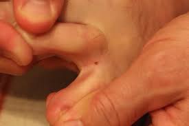 Are Moles on Toes High Risk for Melanoma?