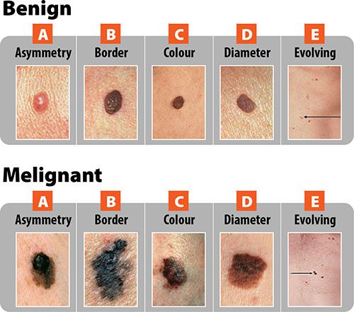 Do ABCDEs Always Apply to Melanoma; Can Cancer Look Normal?