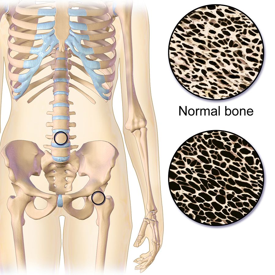 What Would Cause a 30-Year-Old to Have Osteoporosis?