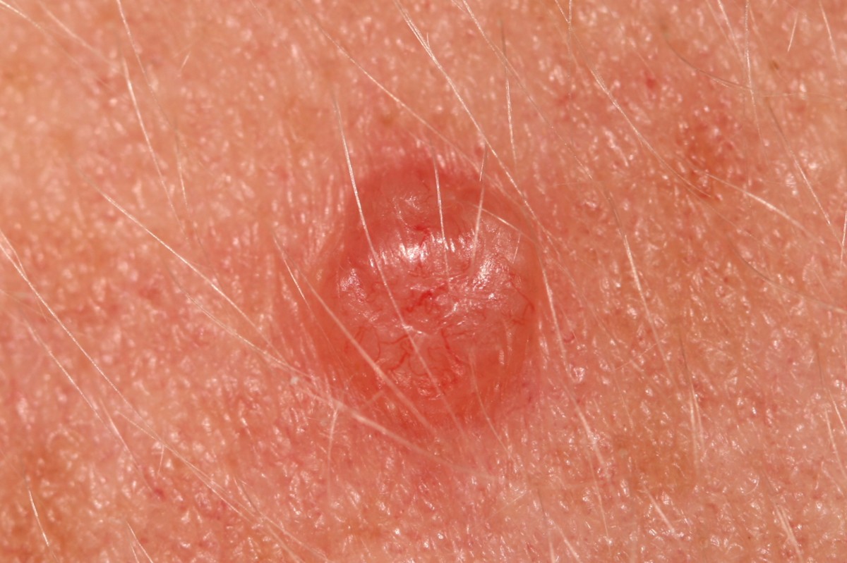 When Cancer Can Mimic an Earlobe Pimple Know the Signs » Scary Symptoms