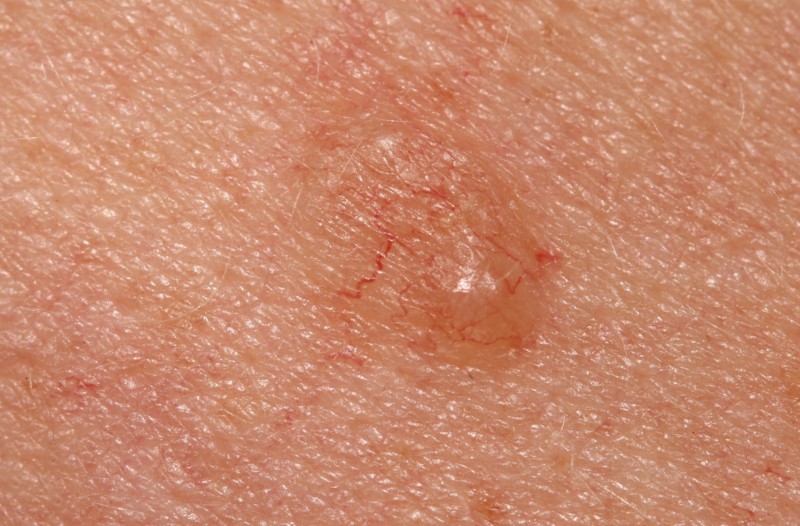 What Skin Cancer Looks Like A Pimple