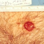 Can People Ever Smell Skin Cancer?