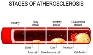 what causes belching