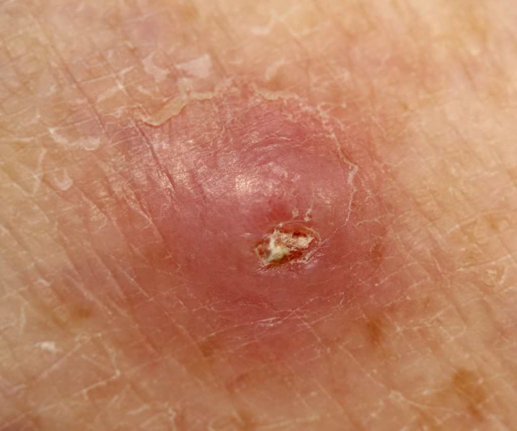 When Cancer Can Mimic an Earlobe Pimple Know the Signs » Scary Symptoms