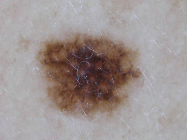 Edge of Longstanding Mole Is Coming Away from Skin: Melanoma? » Scary ...