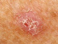 Flaky Dry Patches on Forehead: Causes, Solutions » Scary Symptoms