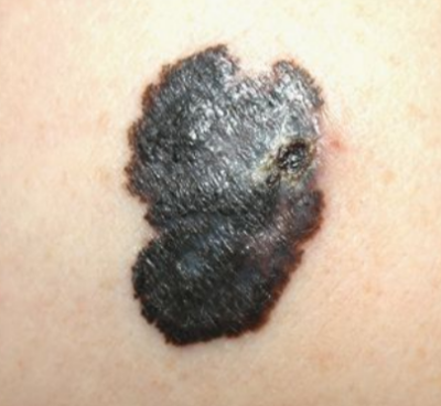 24 Conditions that Mimic Melanoma to the Naked Eye » Scary Symptoms